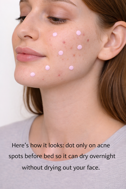 Acne Drying Lotion